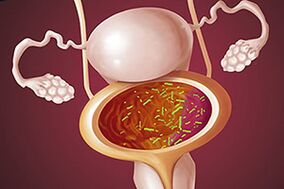Bakterijski cistitis pri ženski